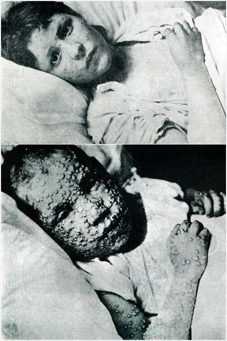 Smallpox