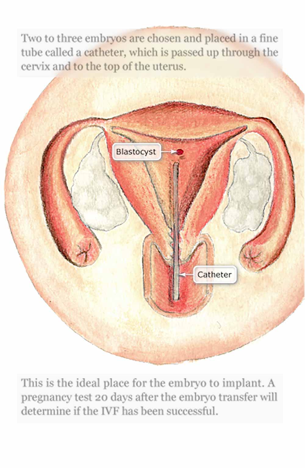 Embryo transfer