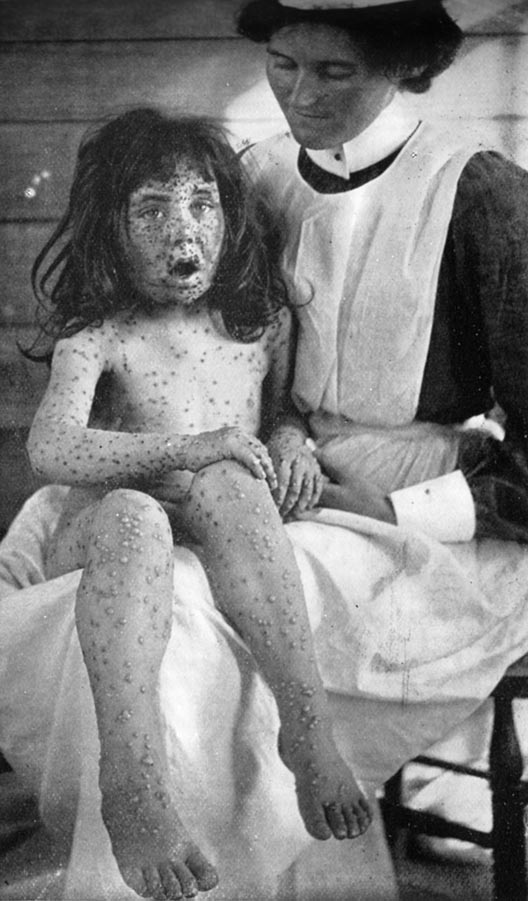 A young girl with spots all over her body sits on a nurse’s knee.
