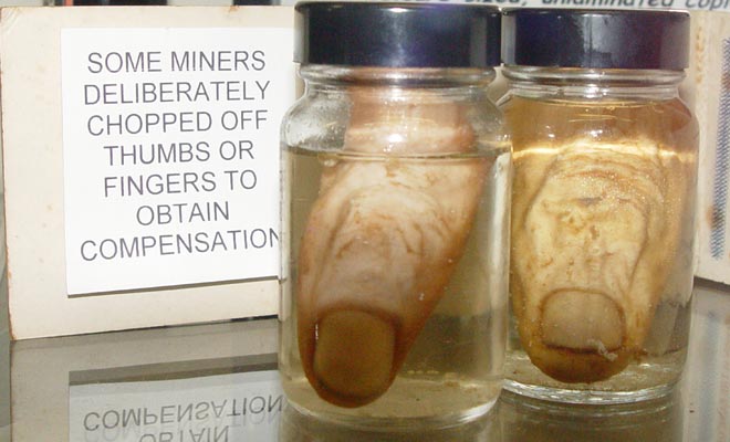Miners' thumbs