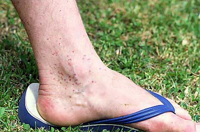 Sandfly bites