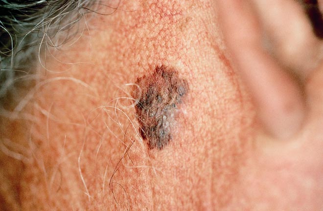 Melanoma