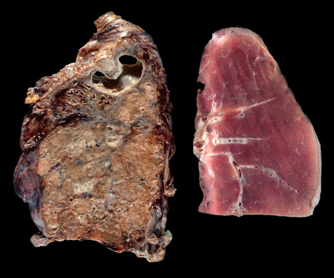 Diseased and healthy lung 