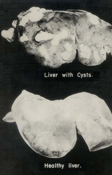 Hydatids infection