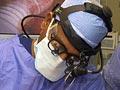 Separating conjoined twins