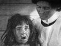 Child with smallpox, 1904