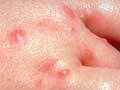Bitten hand