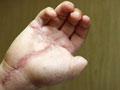 Reattached fingers