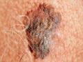 Melanoma