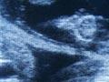 Ultrasound scanning