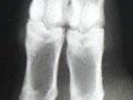 Foot abscess in a sheep