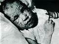 Smallpox